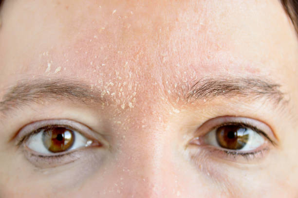 White brunette with dark brown eyes showing dry skin on forehead