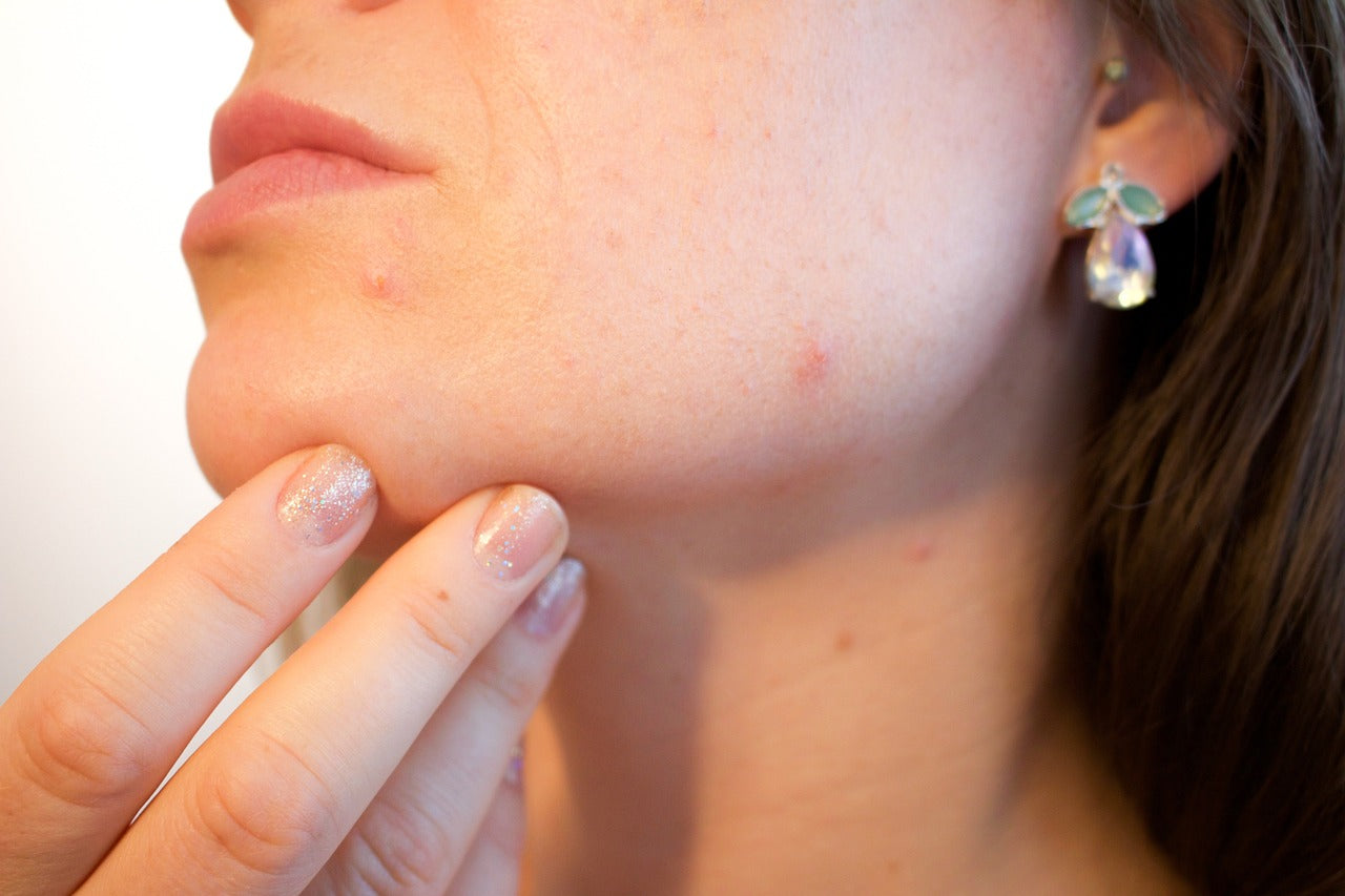 White brunette female with acne on face